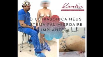 Lipoescultura
