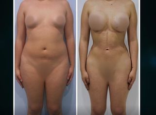 LIPOESCULTURA