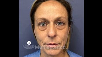 Blefaroplastia - Dr. Sergio Guillermo Ramírez Ledesma