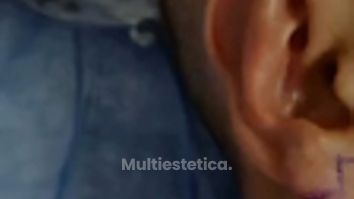 Reduce o modifica la forma del lóbulo de tu oreja - Dr. Alejandro Cruz Segura