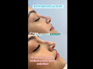 Rinomodelación - Joyas Clinique Spa