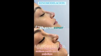 Rinomodelación - Joyas Clinique Spa