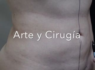 Liposucción - Dr. Sigfrido García Román
