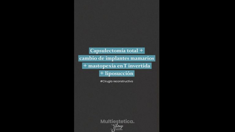 Mastopexia - Dr. Jhony Camarero