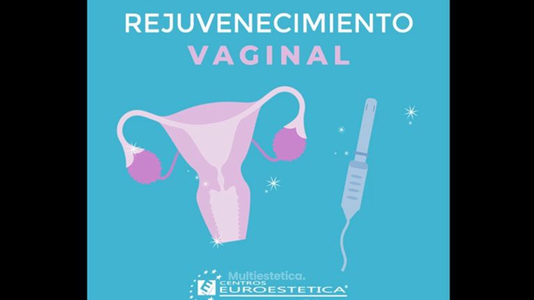 Rejuvenecimiento Vaginal - Centros Euroestetica Toluca