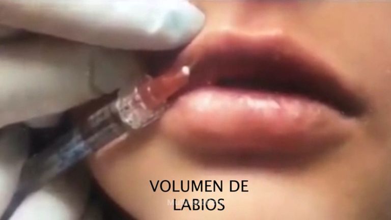 Aumento de Labios