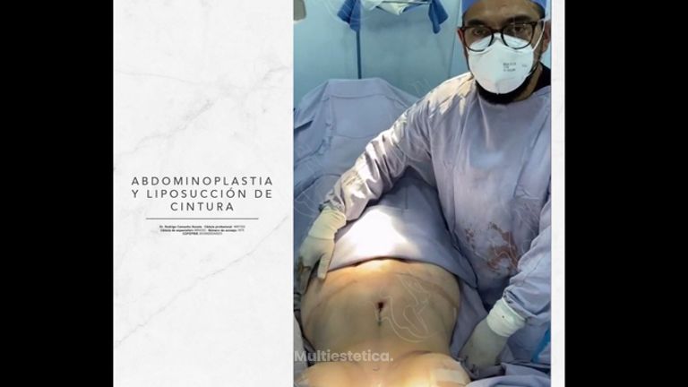 Lipoabdominoplastia - Dr. Rodrigo Camacho Acosta