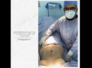 Lipoabdominoplastia - Dr. Rodrigo Camacho Acosta