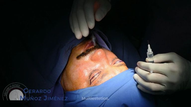 Rinoplastia + Blefaroplastia - Dr. Gerardo Muñoz Jiménez