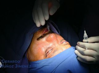 Rinoplastia + Blefaroplastia - Dr. Gerardo Muñoz Jiménez
