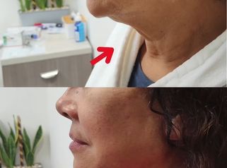 Lifting mandibula y cuello -Dr. Alejandro Cruz Segura