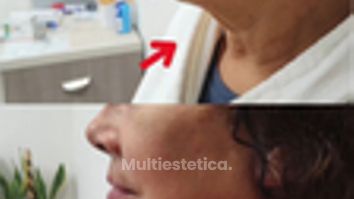 Lifting mandibula y cuello  -Dr. Alejandro Cruz Segura