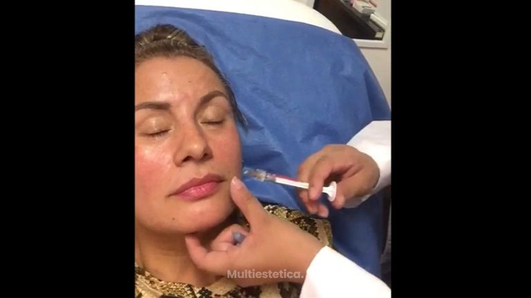 Aumento de labios con ácido hialurónico