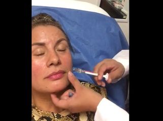 Aumento de labios con ácido hialurónico