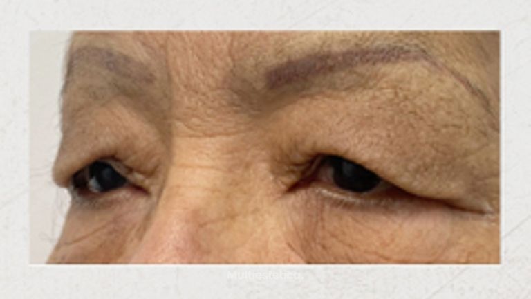 Blefaroplastia - Dra. Maria Antonia Hernández Sepúlveda