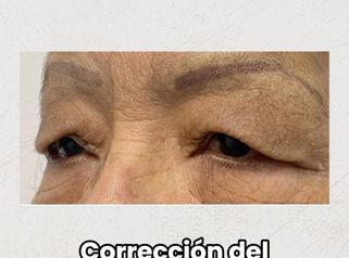 Blefaroplastia - Dra. Maria Antonia Hernández Sepúlveda