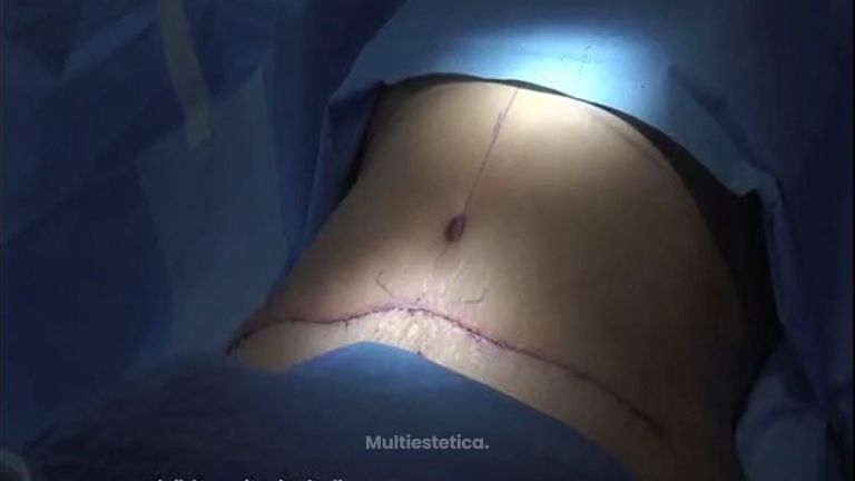 Abdominoplastia