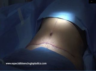 Abdominoplastia