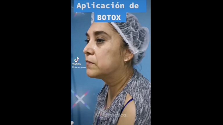 Toxina Botulínica - Dra. Zuleyma Lili Juarez Gutierrez
