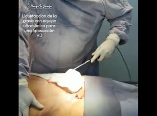 Liposucción  - Dr. Humberto Osnaya Moreno