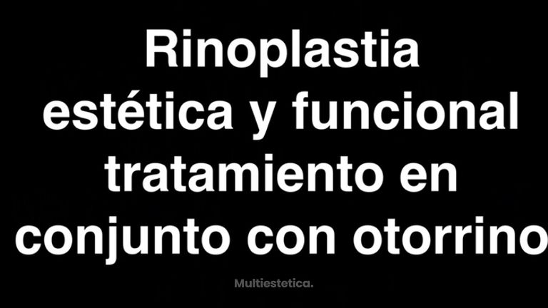 RINOPLASTIA ESTETICA Y FUNCIONAL
