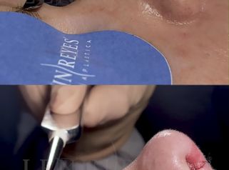 Rinoplastia - Dr. Lenin Alfonso Reyes Ibarra