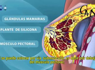 Tipos de colocación del implante mamario - Dra Grissel Mayen Silva - Cirugía Plástica Cosmédica