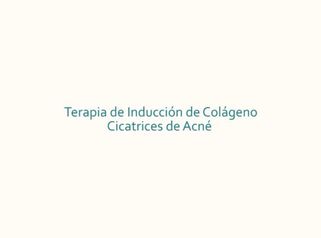 Terapia de Inducción De Colágeno para Cicatrices de Acné