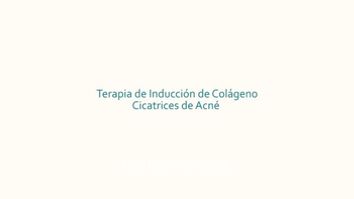 Terapia de Inducción De Colágeno para Cicatrices de Acné