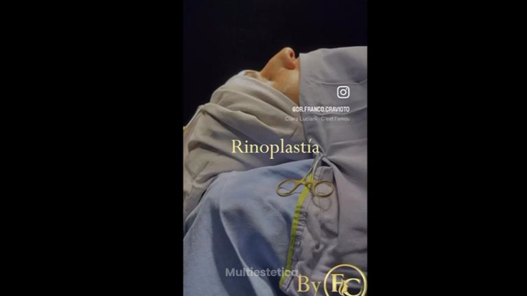 Rinoplastia - Dr. Franco Cravioto