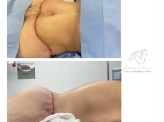 Abdominoplastia 