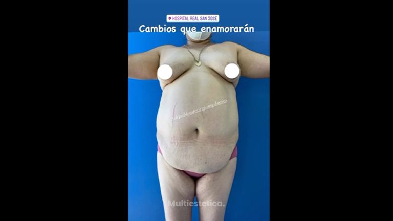 Mommy makeover - Dr. Pablo Soto