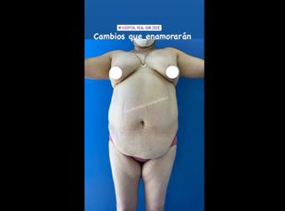 Mommy makeover - Dr. Pablo Soto