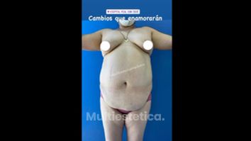 Mommy makeover - Dr. Pablo Soto