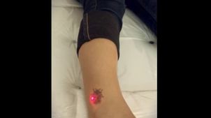 Eliminar tatuajes Eliminar tatuajes