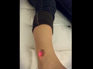 Eliminación de tatuajes