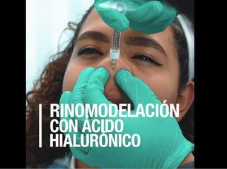 Rinomodelación con Ácido Hialurónico