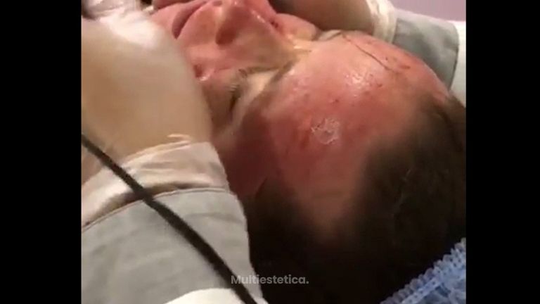 Terapia de inducción al colágeno