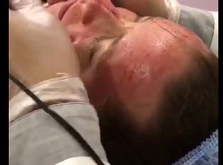 Terapia de inducción al colágeno