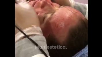 Terapia de inducción al colágeno