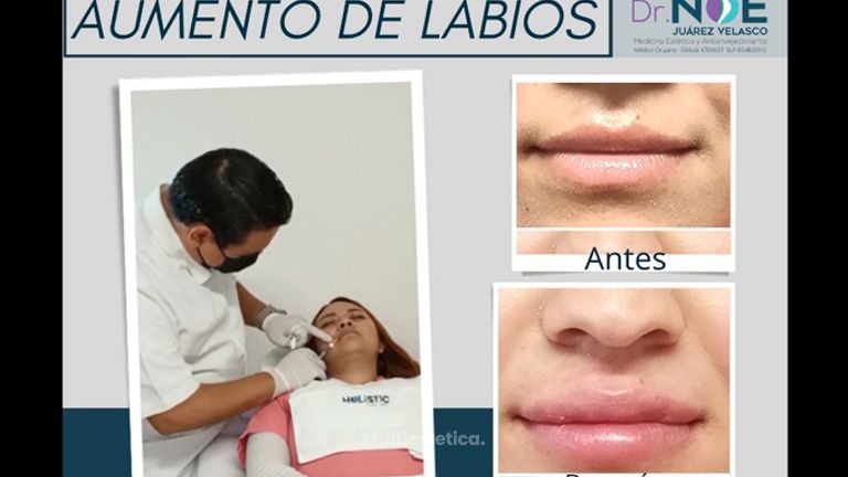Aumento de labios - Dr. Rafael Noé Juárez Velasco