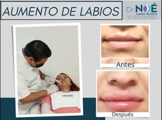 Aumento de labios - Dr. Rafael Noé Juárez Velasco