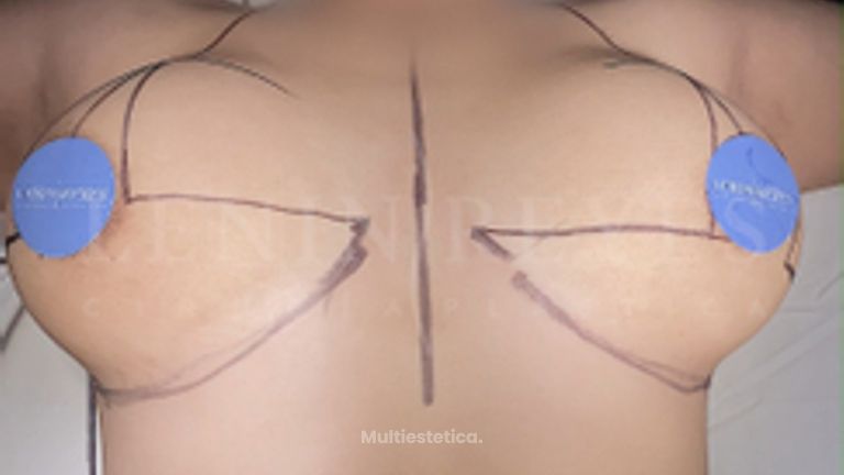 Mastopexia - Dr. Lenin Alfonso Reyes Ibarra