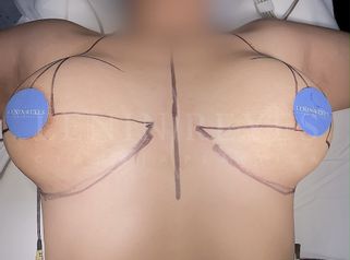 Mastopexia - Dr. Lenin Alfonso Reyes Ibarra