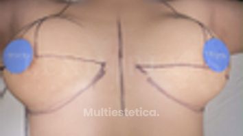Mastopexia - Dr. Lenin Alfonso Reyes Ibarra