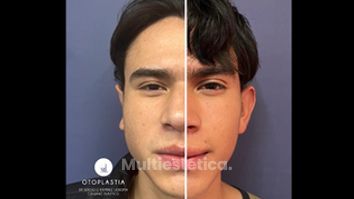 Otoplastia - Dr. Sergio Guillermo Ramírez Ledesma