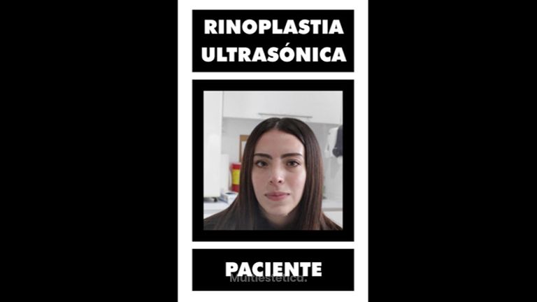 Rinoplastia - Dr. Lenin Alfonso Reyes Ibarra