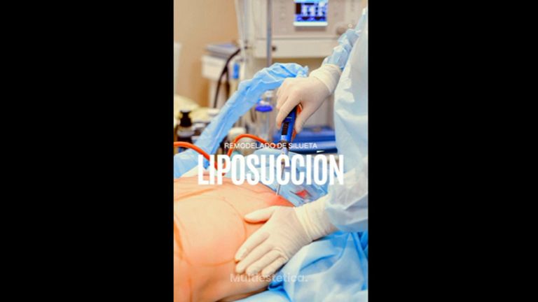 Liposucción - Dr. Gerardo Rayón Nieva