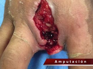 Así se reconstruye una mano tras una mordedura humana
