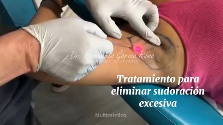 Hiperhidrosis Axilar - Dr. Jorge Humberto García Romo